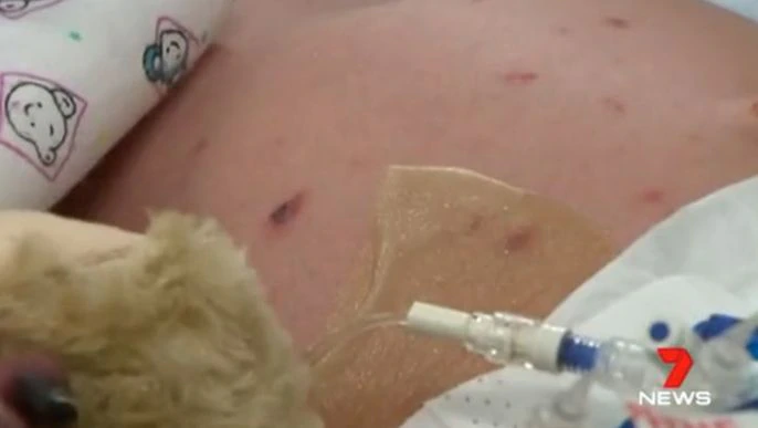 Tasmanian woman contracts meningococcal disease – 7NEWS