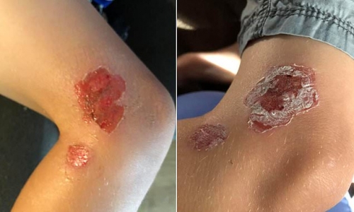 Young boy contracts a flesh-eating bacteria while swimming at a beach in Maryland – Daily Mail