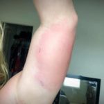 Florida man contracts flesh-eating bacteria without even touching water – CBS News