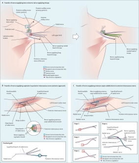 Expanding traditional tendon-based techniques with nerve transfers for the restoration of upper limb function in tetraplegia: a prospective case series – The Lancet