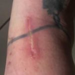Central Florida woman contracted marine bacteria after she nicked her ankle shaving – WESH 2 Orlando