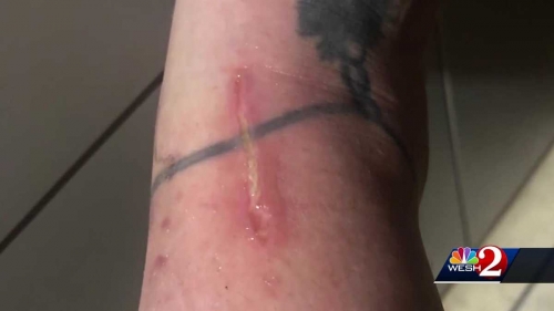 Central Florida woman contracted marine bacteria after she nicked her ankle shaving – WESH 2 Orlando
