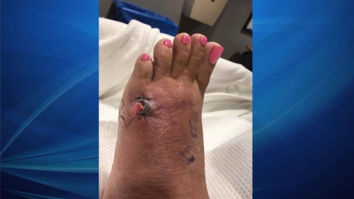 Port Charlotte woman gets flesh-eating bacteria in foot at popular Florida beach – WFLA