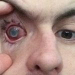 Man blinded by parasite after showering with contacts in – Fox News