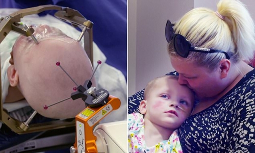 Two-year-old girl becomes the youngest patient EVER to receive deep brain stimulation therapy – Daily Mail