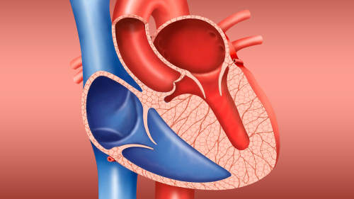 A Better Idea of When Mild HCM Is Likely to Go Downhill Fast