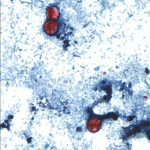 Outbreak of Cyclosporiasis Grows to More than 1,000 Cases
