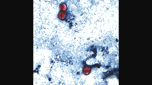 Outbreak of Cyclosporiasis Grows to More than 1,000 Cases