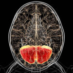 Modified Amino Acid Improves Neurologic Symptoms in Rare Genetic Disorder