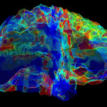 Next generation Alzheimer’s drug reduces risk of serious brain bleeds