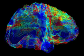 Next generation Alzheimer’s drug reduces risk of serious brain bleeds