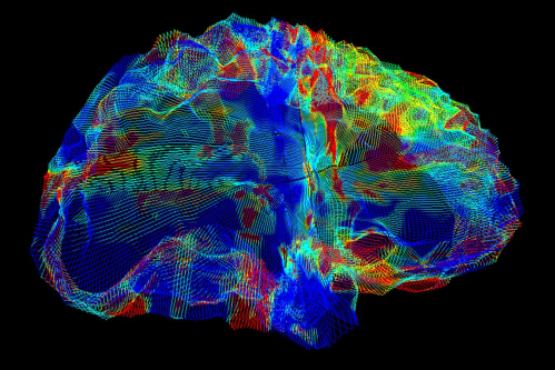 Next generation Alzheimer’s drug reduces risk of serious brain bleeds