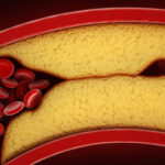FDA approves cholesterol pill more powerful than statins