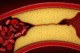 FDA approves cholesterol pill more powerful than statins