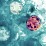 Infections from Cyclospora parasite continue sharp increases