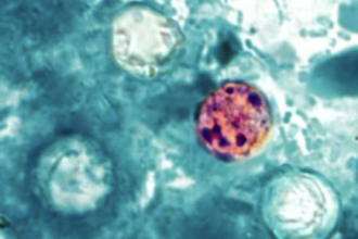Infections from Cyclospora parasite continue sharp increases
