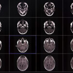 Scientists Studied Over 10,000 Brain Scans. What They Found Changes Everything We Knew About Memory Loss.