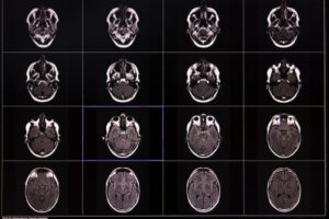 Scientists Studied Over 10,000 Brain Scans. What They Found Changes Everything We Knew About Memory Loss.