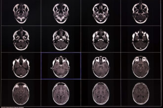 Scientists Studied Over 10,000 Brain Scans. What They Found Changes Everything We Knew About Memory Loss.