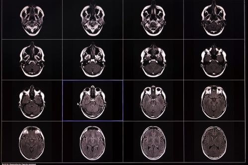 Scientists Studied Over 10,000 Brain Scans. What They Found Changes Everything We Knew About Memory Loss.