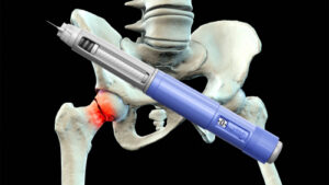 Study Links GLP-1s to Lower Risk of Fragility Fractures in Diabetes Patients