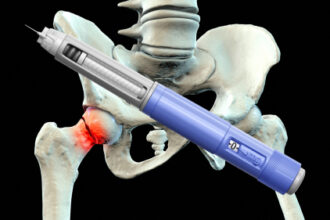 Study Links GLP-1s to Lower Risk of Fragility Fractures in Diabetes Patients