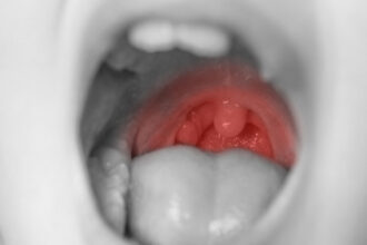 Oral Steroids After Tonsillectomy May Modestly Cut Kids’ Pain