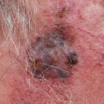 Twice-Rejected Melanoma Drug Gets Surprise Love From FDA Panel