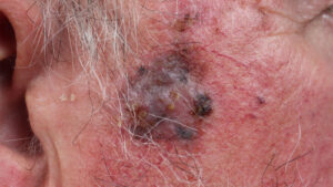 Twice-Rejected Melanoma Drug Gets Surprise Love From FDA Panel