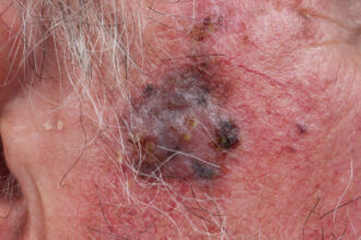 Twice-Rejected Melanoma Drug Gets Surprise Love From FDA Panel