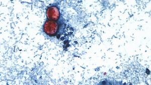 Michigan Reports First Two U.S. Deaths Related to Diarrhea-Causing Parasite