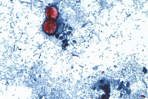 Michigan reports first 2 US deaths in cyclospora outbreak