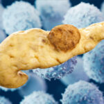 Pancreatic Cancer Vaccine Shows Interception Promise in High-Risk Patients