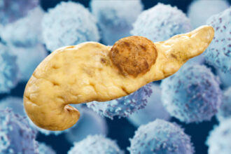 Pancreatic Cancer Vaccine Shows Interception Promise in High-Risk Patients