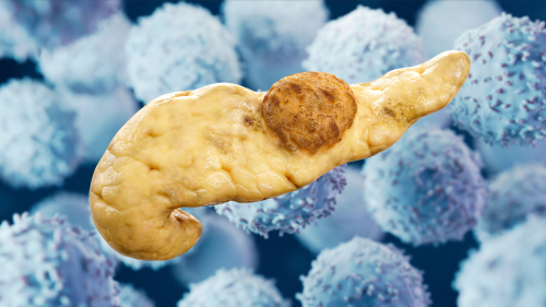Pancreatic Cancer Vaccine Shows Interception Promise in High-Risk Patients