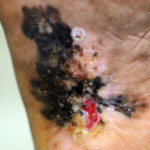 FDA Finally OKs Twice-Rejected Melanoma Drug