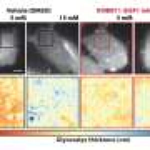 High glucose thickens cancer cells’ sugar shield, helping them evade immune attack