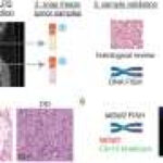 Protein ‘switch’ determines whether liposarcoma cells will become aggressive