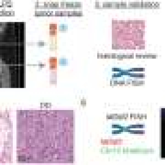 Protein ‘switch’ determines whether liposarcoma cells will become aggressive