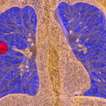 Simple Reminders Boost Lung Cancer Screening Rates