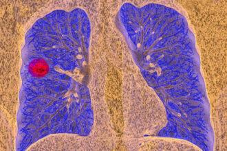 Simple Reminders Boost Lung Cancer Screening Rates
