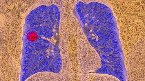 Simple Reminders Boost Lung Cancer Screening Rates