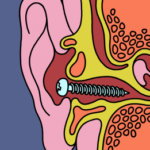 For People with Misophonia, Everyday Noises Can Be Agony