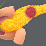 Risk of Pancreatic Cysts Becoming Cancer Grows as Worrisome Traits Increase