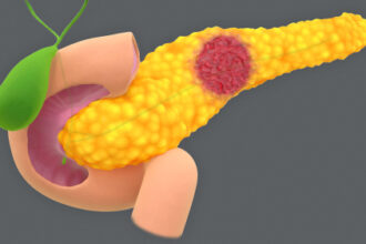 Risk of Pancreatic Cysts Becoming Cancer Grows as Worrisome Traits Increase