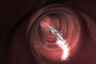 Medtronic Reflux Device Linked to 184 Serious Injuries, FDA Warns