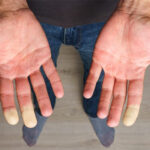 Does Vitamin B3 Benefit Patients With Raynaud Phenomenon?