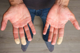 Does Vitamin B3 Benefit Patients With Raynaud Phenomenon?
