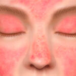 Dramatic Improvement in Dermatomyositis Skin Symptoms With First Approved Oral Agent
