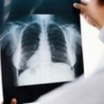 People With Lung Cancer Had Higher Levels of Microplastics in Their Lungs
